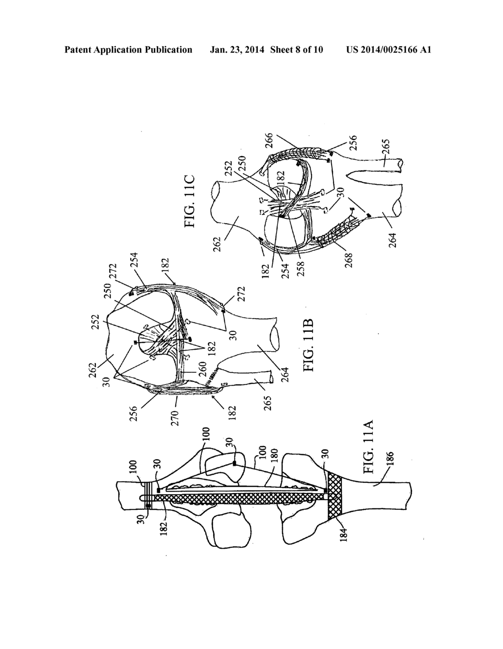 DEVICES AND METHODS FOR STABILIZING TISSUE AND IMPLANTS - diagram, schematic, and image 09