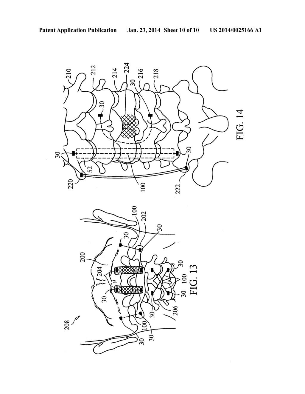 DEVICES AND METHODS FOR STABILIZING TISSUE AND IMPLANTS - diagram, schematic, and image 11