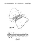 DETACHABLE BUTTRESS MATERIAL RETENTION SYSTEMS FOR USE WITH A SURGICAL     STAPLING DEVICE diagram and image