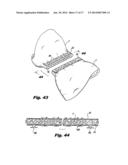 DETACHABLE BUTTRESS MATERIAL RETENTION SYSTEMS FOR USE WITH A SURGICAL     STAPLING DEVICE diagram and image