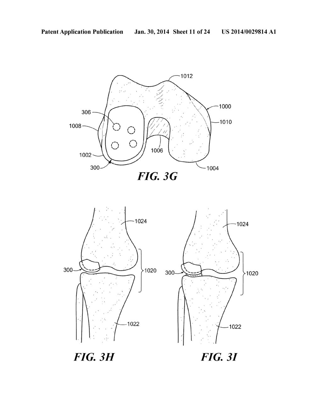 Patient Selectable Knee Arthroplasty Devices - diagram, schematic, and image 12