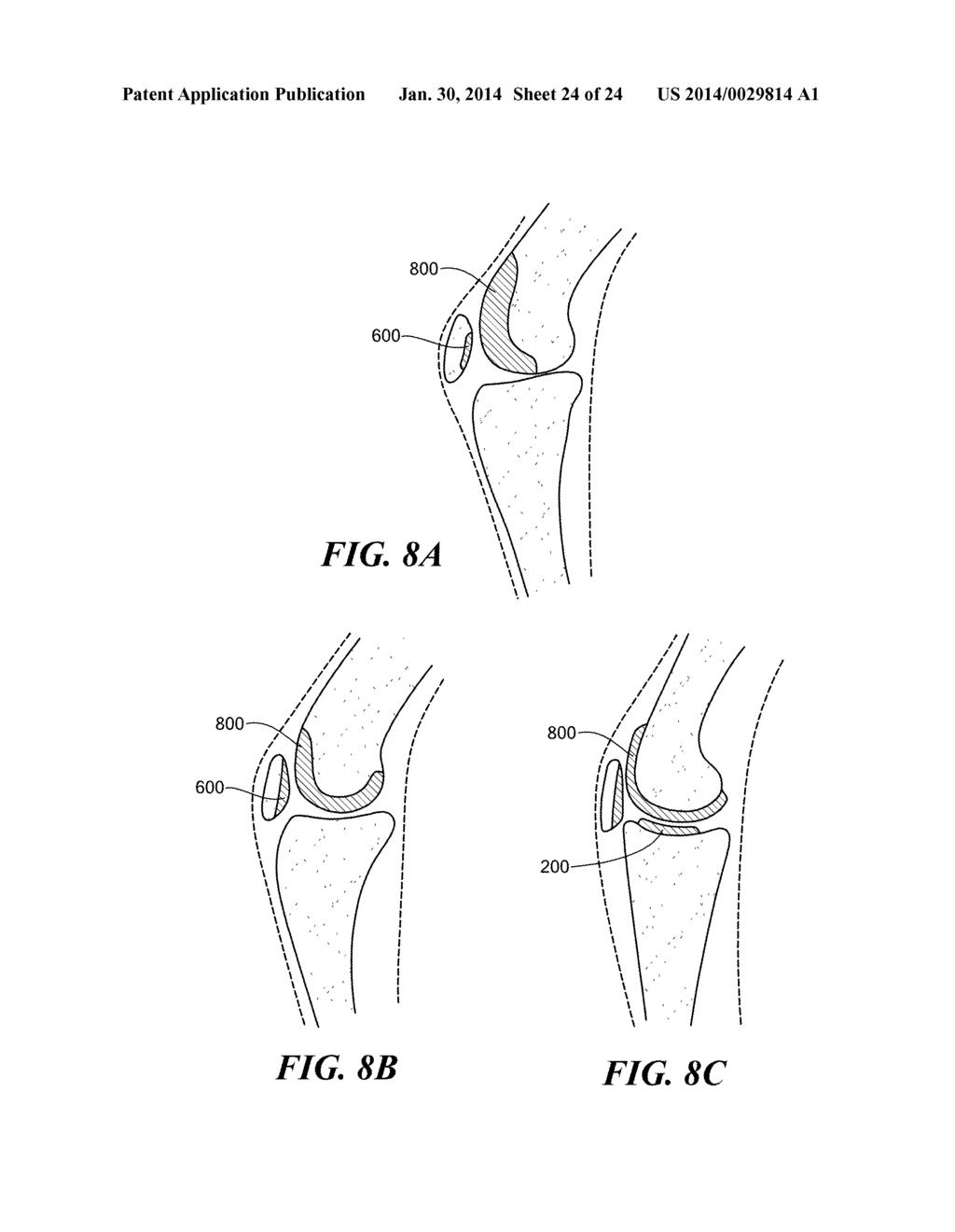 Patient Selectable Knee Arthroplasty Devices - diagram, schematic, and image 25