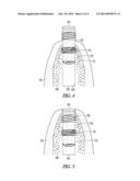 POROUS IMPLANT diagram and image