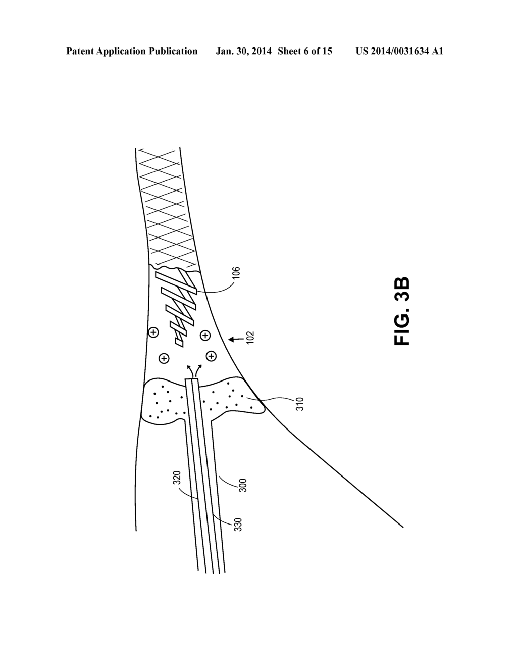 METHODS AND APPARATUS FOR DETERMINING FALLOPIAN TUBE OCCLUSION - diagram, schematic, and image 07