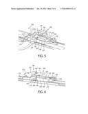 MRI INVOLVING A LOCAL RF COIL BEING MOVABLE RELATIVE TO A PEDIATRIC     PATIENT CARRIER diagram and image