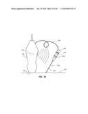 Needle Assembly Including an Aligned Magnetic Element diagram and image