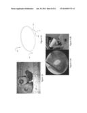 COIL ELECTRODE APPARATUS FOR THERMAL THERAPY FOR TREATING BONE TISSUE diagram and image