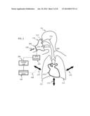 Method and Apparatus for Improved Ventilation and Cardio-Pulmonary     Resuscitation diagram and image