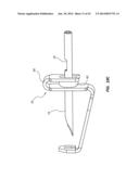 Catheter Placement Device and Method diagram and image