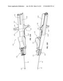 Catheter Placement Device and Method diagram and image