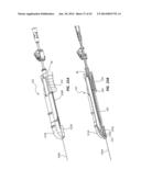 Catheter Placement Device and Method diagram and image