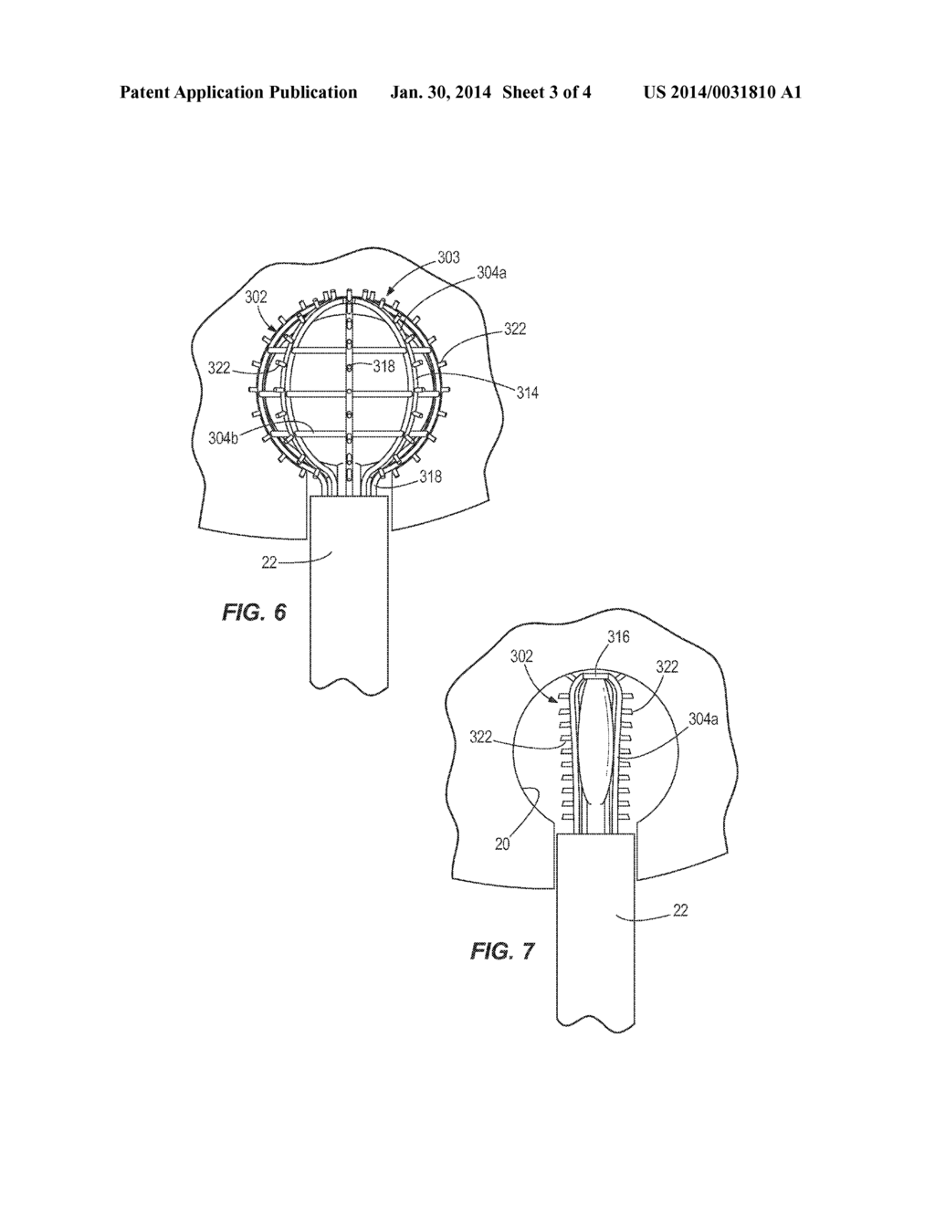 Radiofrequency Probe for Circumferential Ablation of a Hollow Cavity - diagram, schematic, and image 04