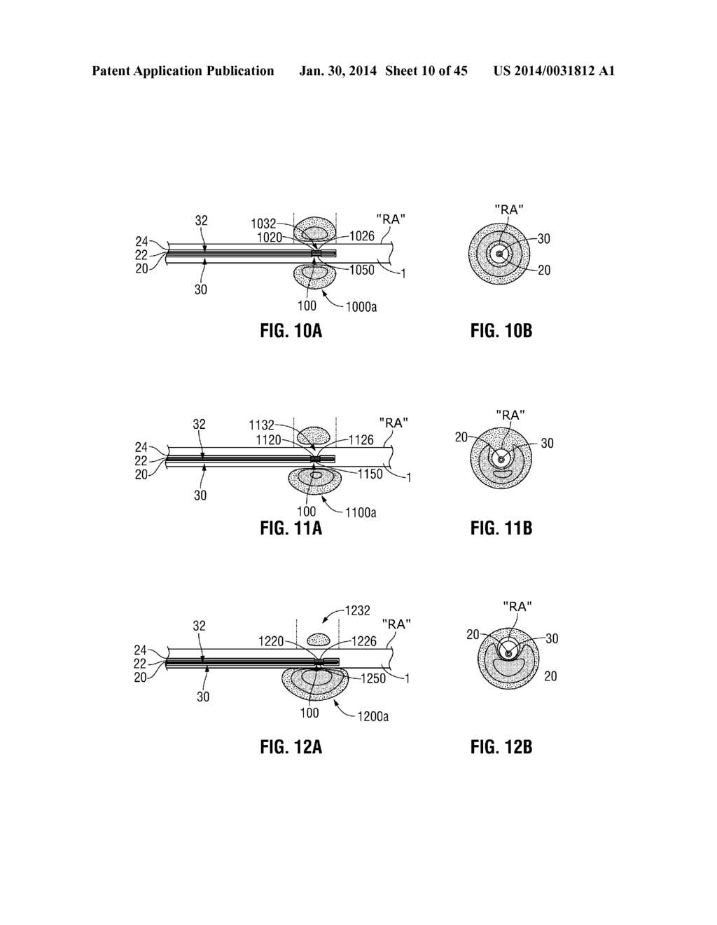 FLEXIBLE MICROWAVE CATHETERS FOR NATURAL OR ARTIFICIAL LUMENS - diagram, schematic, and image 11