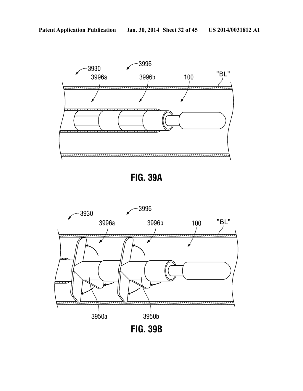 FLEXIBLE MICROWAVE CATHETERS FOR NATURAL OR ARTIFICIAL LUMENS - diagram, schematic, and image 33