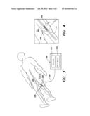 DEPOSIT ABLATION WITHIN AND EXTERNAL TO CIRCULATORY SYSTEMS diagram and image