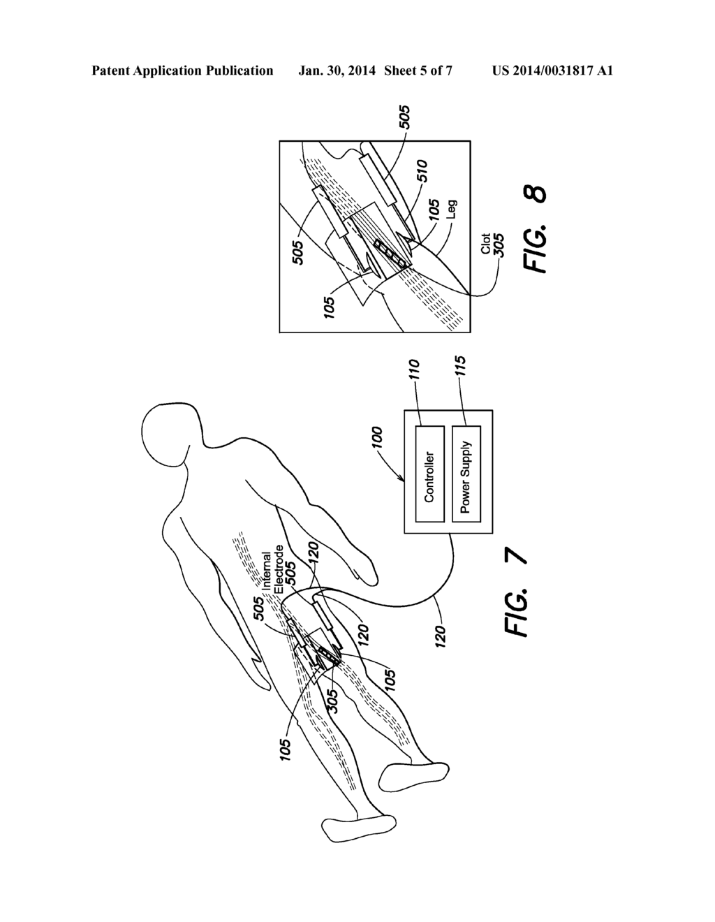 DEPOSIT ABLATION WITHIN AND EXTERNAL TO CIRCULATORY SYSTEMS - diagram, schematic, and image 06