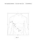 METHOD AND DEVICES FOR PERFORMING BIATRIAL COAGULATION diagram and image