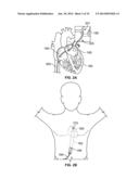 METHOD AND DEVICES FOR PERFORMING BIATRIAL COAGULATION diagram and image