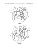 METHOD AND DEVICES FOR PERFORMING BIATRIAL COAGULATION diagram and image