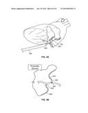 METHOD AND DEVICES FOR PERFORMING BIATRIAL COAGULATION diagram and image