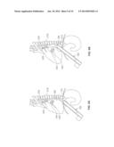 METHOD AND DEVICES FOR PERFORMING BIATRIAL COAGULATION diagram and image