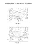 METHOD AND DEVICES FOR PERFORMING BIATRIAL COAGULATION diagram and image