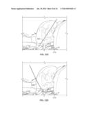 METHOD AND DEVICES FOR PERFORMING BIATRIAL COAGULATION diagram and image