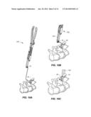 BONE FASTENER ASSEMBLY INSTRUMENT diagram and image