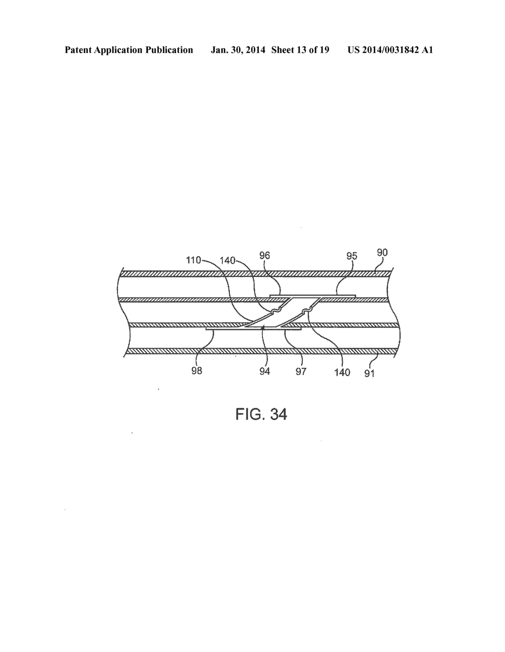 DEVICE AND METHOD FOR ESTABLISHING AN ARTIFICIAL ARTERIO-VENOUS FISTULA - diagram, schematic, and image 14