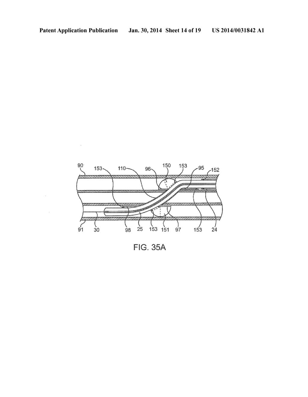 DEVICE AND METHOD FOR ESTABLISHING AN ARTIFICIAL ARTERIO-VENOUS FISTULA - diagram, schematic, and image 15