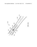 DEVICE AND METHOD FOR TREATING A VESSEL diagram and image