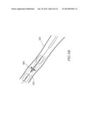 DEVICE AND METHOD FOR TREATING A VESSEL diagram and image