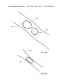 DEVICE AND METHOD FOR TREATING A VESSEL diagram and image