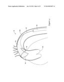 EMBOLIC PROTECTION FILTER FOR TRANSCATHETER AORTIC VALVE REPLACEMENT AND     USES THEREOF diagram and image