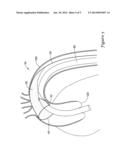 EMBOLIC PROTECTION FILTER FOR TRANSCATHETER AORTIC VALVE REPLACEMENT AND     USES THEREOF diagram and image