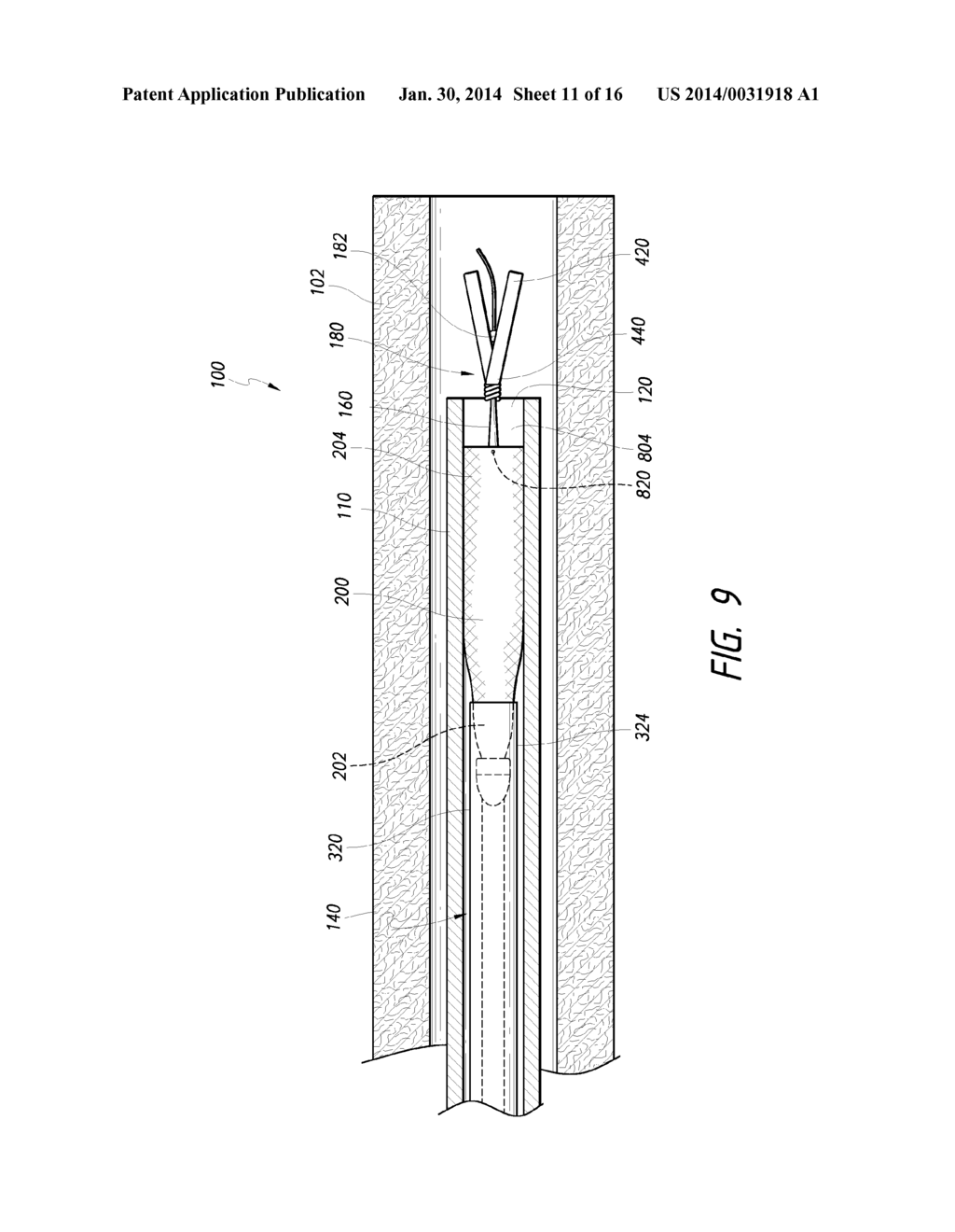 LUMINAL STENTING - diagram, schematic, and image 12