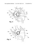 IMPLANTABLE DEVICES FOR CONTROLLING THE INTERNAL CIRCUMFERENCE OF AN     ANATOMIC ORIFICE OR LUMEN diagram and image