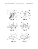 IMPLANTABLE DEVICES FOR CONTROLLING THE INTERNAL CIRCUMFERENCE OF AN     ANATOMIC ORIFICE OR LUMEN diagram and image