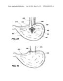 IMPLANTABLE DEVICES FOR CONTROLLING THE INTERNAL CIRCUMFERENCE OF AN     ANATOMIC ORIFICE OR LUMEN diagram and image