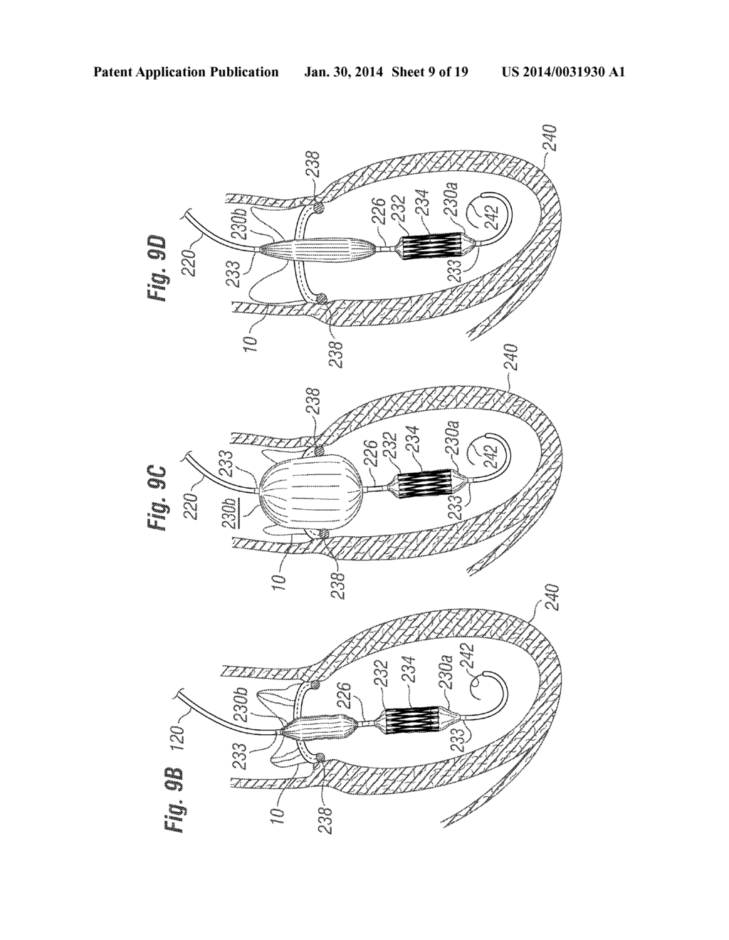 CARDIAC IMPLANT CONFIGURED TO RECEIVE A PERCUTANEOUS PROSTHETIC HEART     VALVE IMPLANTATION - diagram, schematic, and image 10