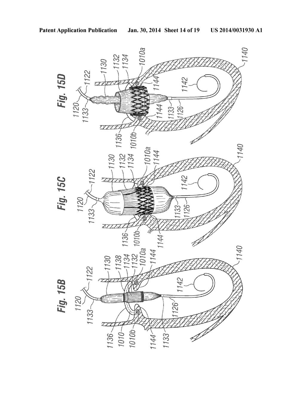 CARDIAC IMPLANT CONFIGURED TO RECEIVE A PERCUTANEOUS PROSTHETIC HEART     VALVE IMPLANTATION - diagram, schematic, and image 15