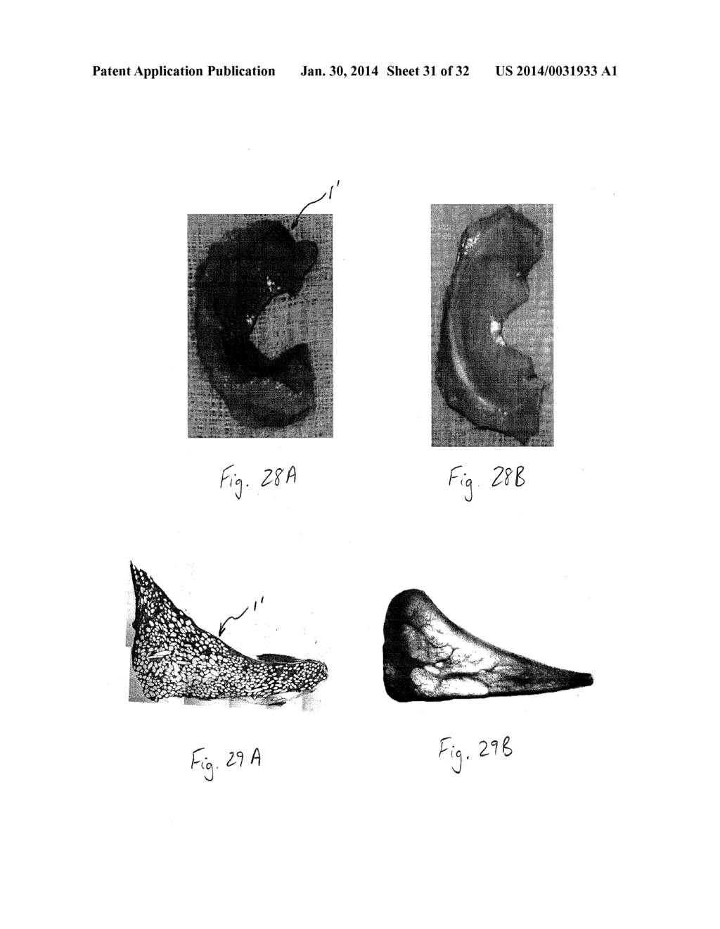 IMPLANTABLE DEVICE AND METHOD TO REPLACE THE MENISCUS OF THE KNEE AND     OTHER BODY STRUCTURES - diagram, schematic, and image 32