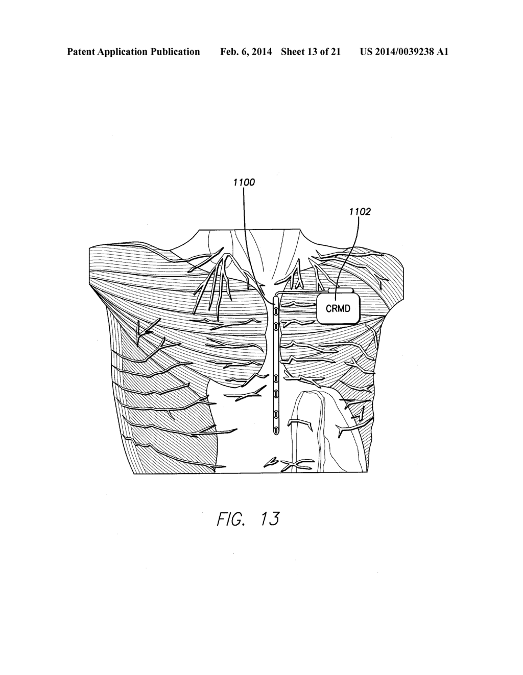 SYSTEMS AND METHODS FOR CONTROLLING NEUROSTIMULATION OF ACUPUNCTURE SITES     USING AN IMPLANTABLE CARDIAC RHYTHM MANAGEMENT DEVICE - diagram, schematic, and image 14