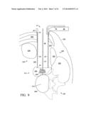 Two-Stage Spinal Access Channel with Psoas Docking diagram and image