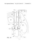 Two-Stage Spinal Access Channel with Psoas Docking diagram and image