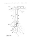 Two-Stage Spinal Access Channel with Psoas Docking diagram and image