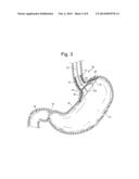 BARIATRIC INSTRUCMENT OR ACCESSORY WITH SENSORS diagram and image