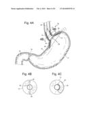 BARIATRIC INSTRUCMENT OR ACCESSORY WITH SENSORS diagram and image