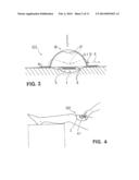 WOUND TREATMENT DEVICE WITH ELASTICALLY DEFORMABLE VACUUM PRODUCING     ELEMENT diagram and image