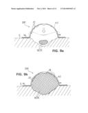 WOUND TREATMENT DEVICE WITH ELASTICALLY DEFORMABLE VACUUM PRODUCING     ELEMENT diagram and image